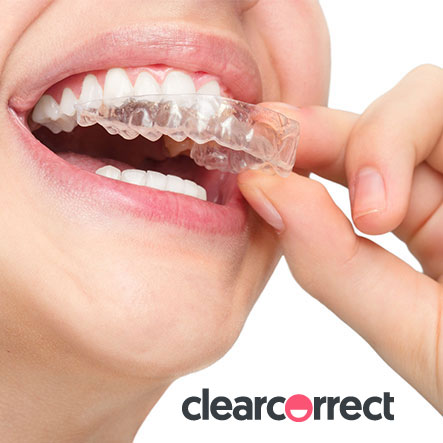 ClearCorrect invisible braces